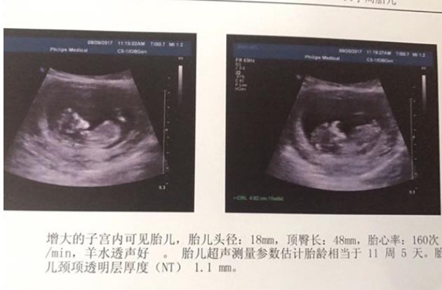 唐山供卵試管 2023在唐山市婦幼保健院做試管嬰兒能保證選男胚女胚嗎？ ‘懷女兒跟懷兒子b超區別’