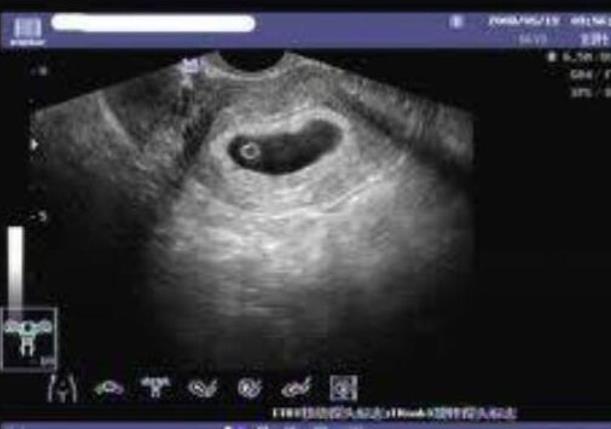 大連試管供卵 大連生殖中心試管嬰兒：怎樣才能做試管嬰兒成功？ ‘做四維看見寶寶有尿男孩女孩’