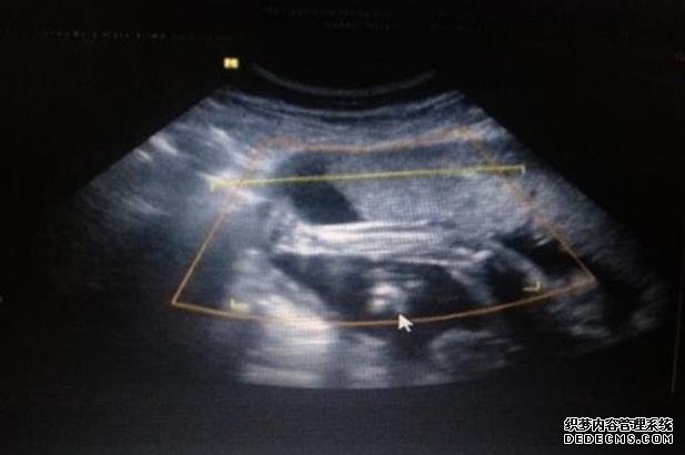 石家莊代孕手術費用 石家莊私人試管醫院,做試管沒做好這些準備可不行！ ‘3個月彩超怎么看男孩女孩三個月的彩超’