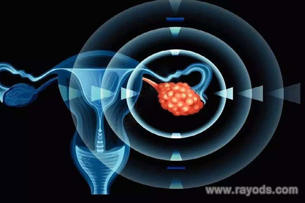 巧克力囊腫患者懷孕的幾率有多大
