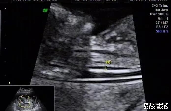 試管并非所有女性都需要做宮腔鏡，移植前出現異常更需要做