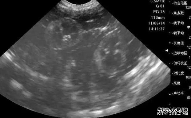 試管移植后保胎很重要，但并不是保胎越久越安全