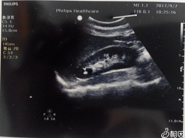 B超是二維圖像