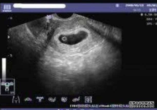 無錫借卵子生子的過程 2無錫101醫院做試管成功率能達到多少? ‘代孕9周懷男孩彩超圖’