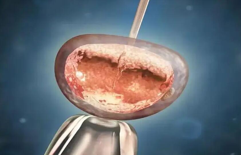 泰國試管嬰兒真實經歷試管嬰兒要注重哪些環節?