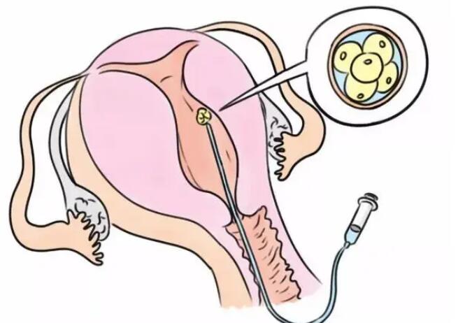 東營試管供卵 2023
東營試管費用納入醫保了嗎？ ‘b超看屁股查男女準嗎’