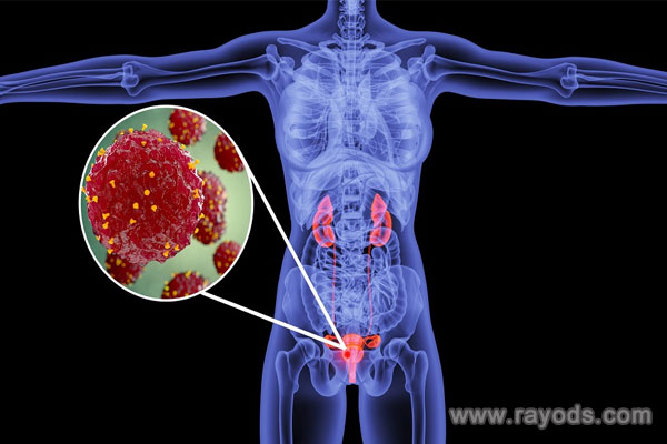 巧囊的最佳治療時間為月經后