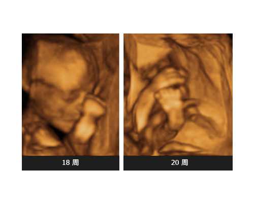 我在潮州市中心醫(yī)院從人工授精轉(zhuǎn)做試管的經(jīng)歷